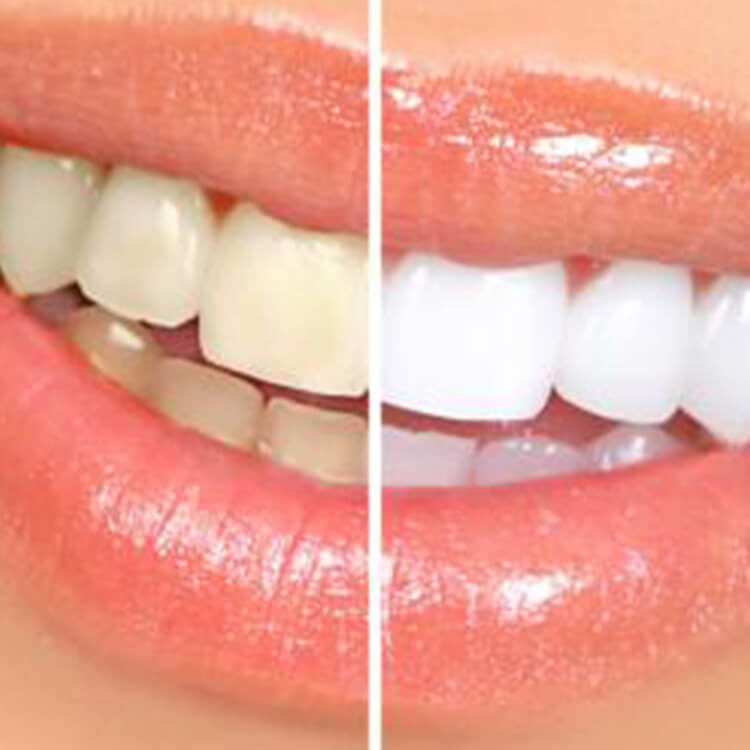 Your Signature Smile - Dr Kenyon Oyler - Meridian, Idaho - SP Cosmetic Dentistry