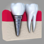 Your Signature Smile - Dr Kenyon Oyler - Meridian, Idaho - SP Restorative Dentistry