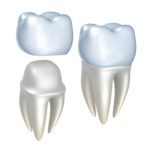 Signature Smiles-Kenyon Oyler DDS-Meridian Dentist-crowns