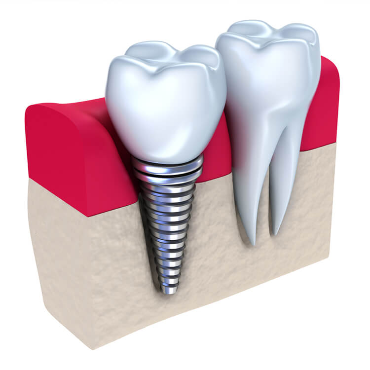 Signature Smiles-Kenyon Oyler DDS-Meridian Dentist-dental implants