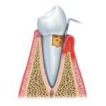Signature Smiles-Kenyon Oyler DDS-Meridian Dentist-periodontal care