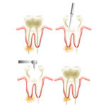 Signature Smiles-Kenyon Oyler DDS-Meridian Dentist-root canal