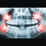Signature Smiles-Kenyon Oyler DDS-Meridian Dentist-wisdom tooth removal